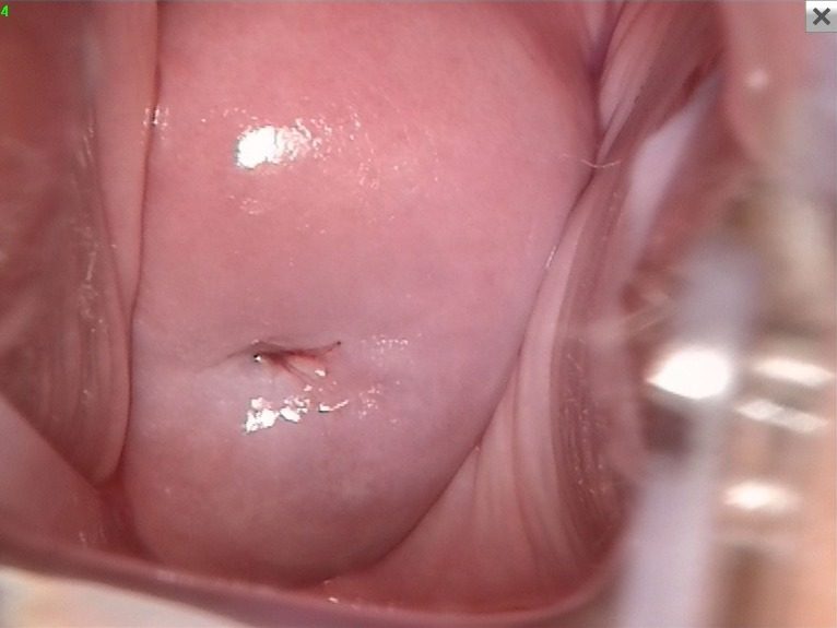 Después - CERVICITIS HERPETICA