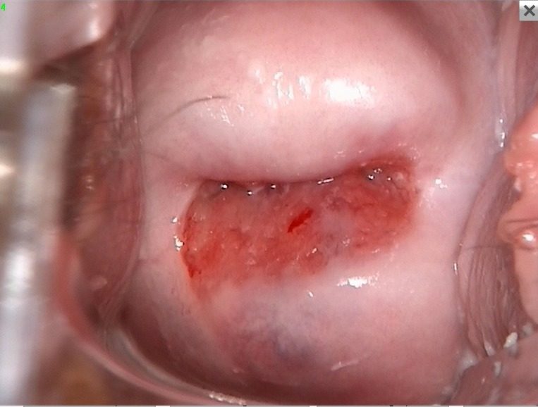 Antes - ECTROPION CERVICAL INFLAMADO