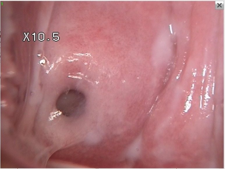 Después - CANDIDIASIS VULVOVAGINAL