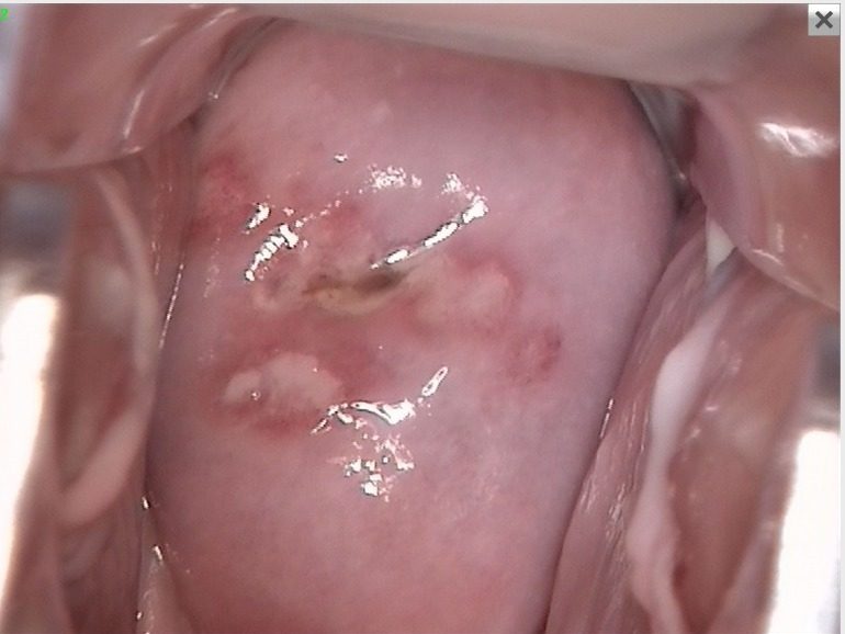 Antes - CERVICITIS HERPETICA