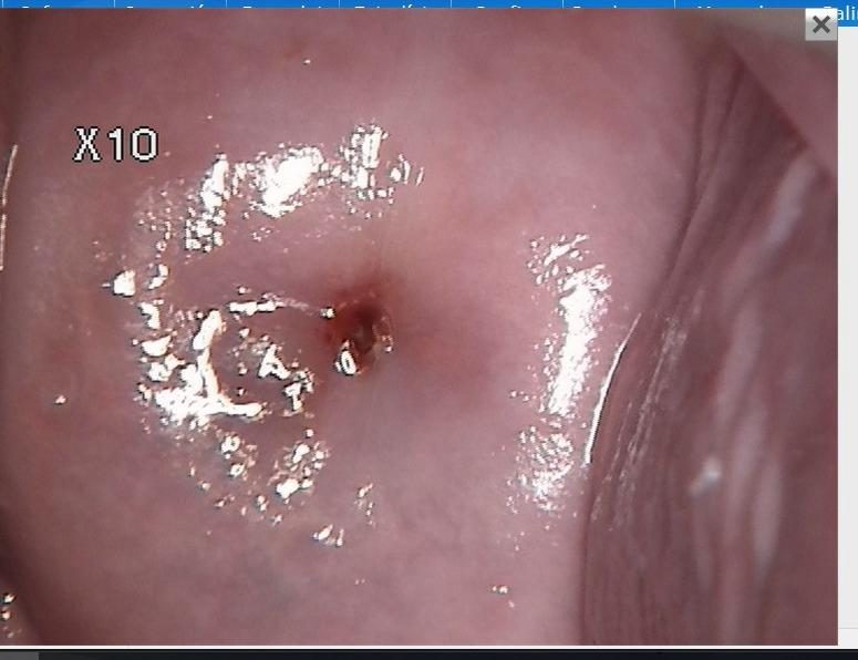 Después - CERVICITIS ASOCIADA A CANDIDIASIS RECURRENTE