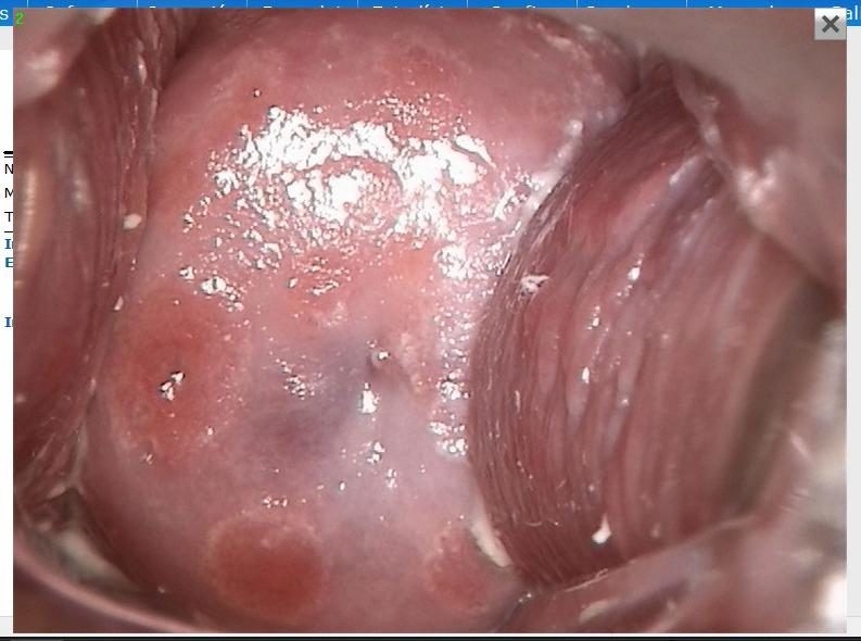 Antes - CERVICITIS ASOCIADA A CANDIDIASIS RECURRENTE
