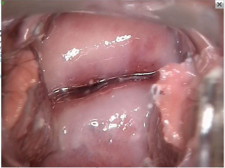 Después - ECTROPION CERVICAL INFLAMADO